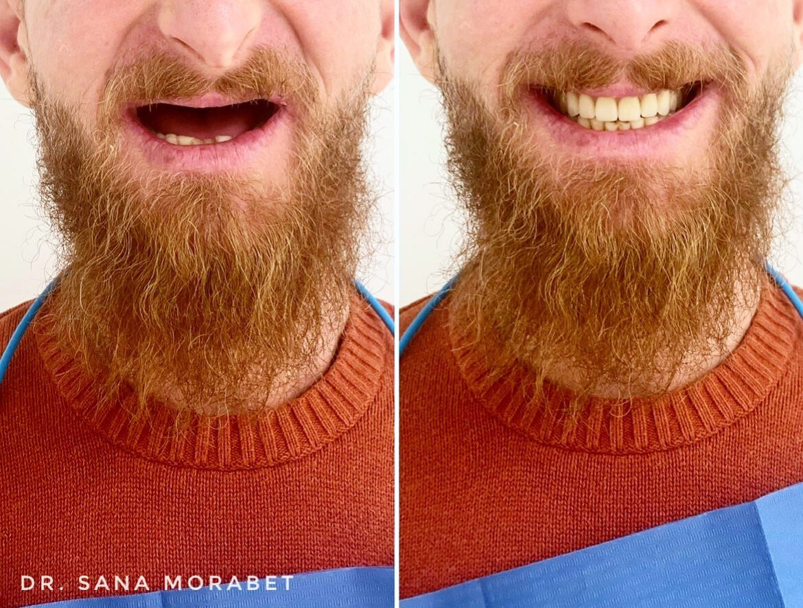 Tandimplantat Före Efter
