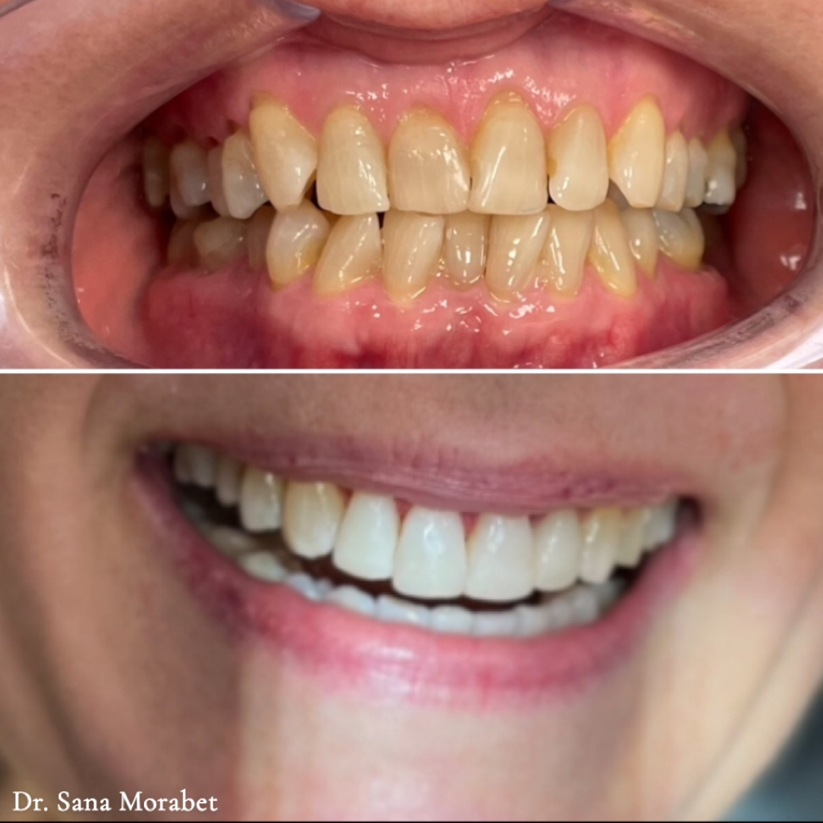 Invisalign Före Efter
