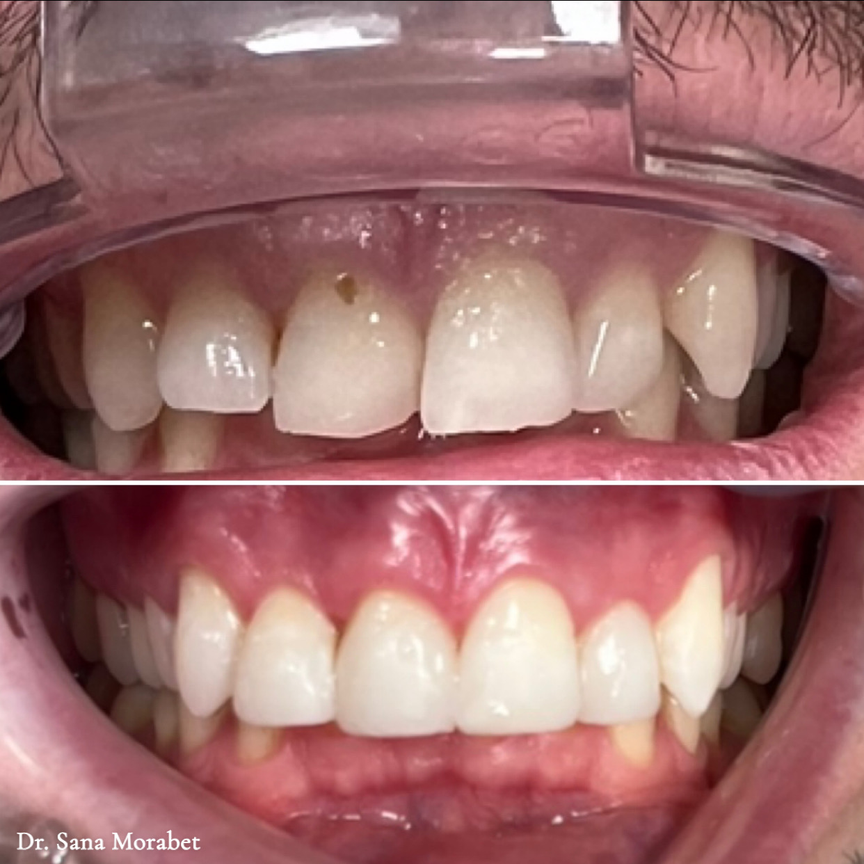 Invisalign Före Efter