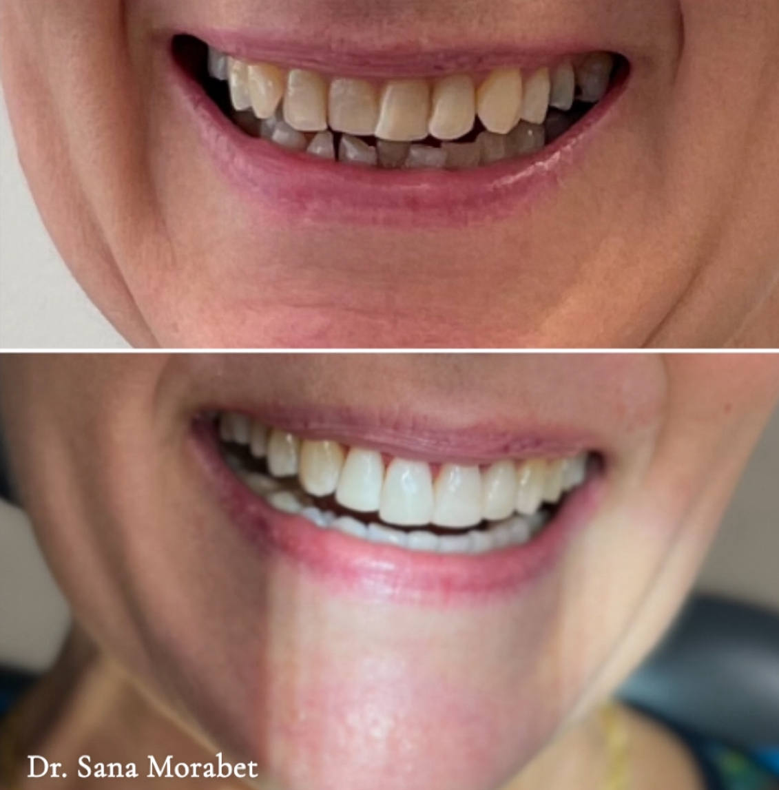 Invisalign Före Efter